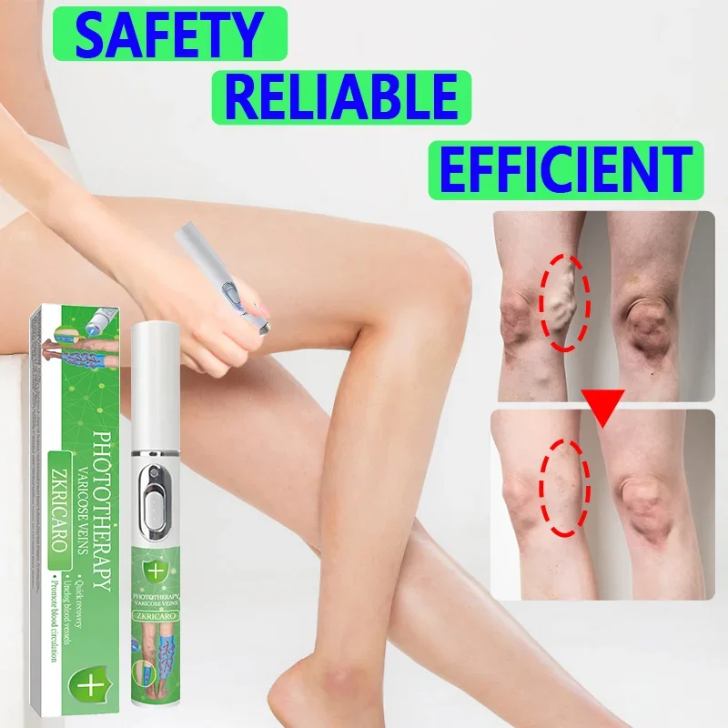 High tech Laser therapy improves moderate varicose veins, Relieves pain and improves circulation in men and women