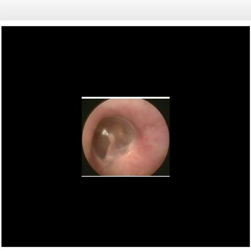 Otoscopio endoscopio de oído 3,9 Mm 4,5 IPS 1080P HD herramientas limpiadoras de extracción de cera con batería recargable de 2500Mah