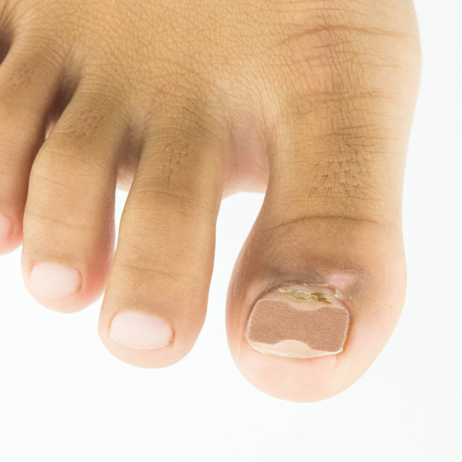 

Ingrown Toenail Sticker Nail Care Patch for Curved Toenails Correction Self-Adhesive Toenail Orthopaedic Stickers