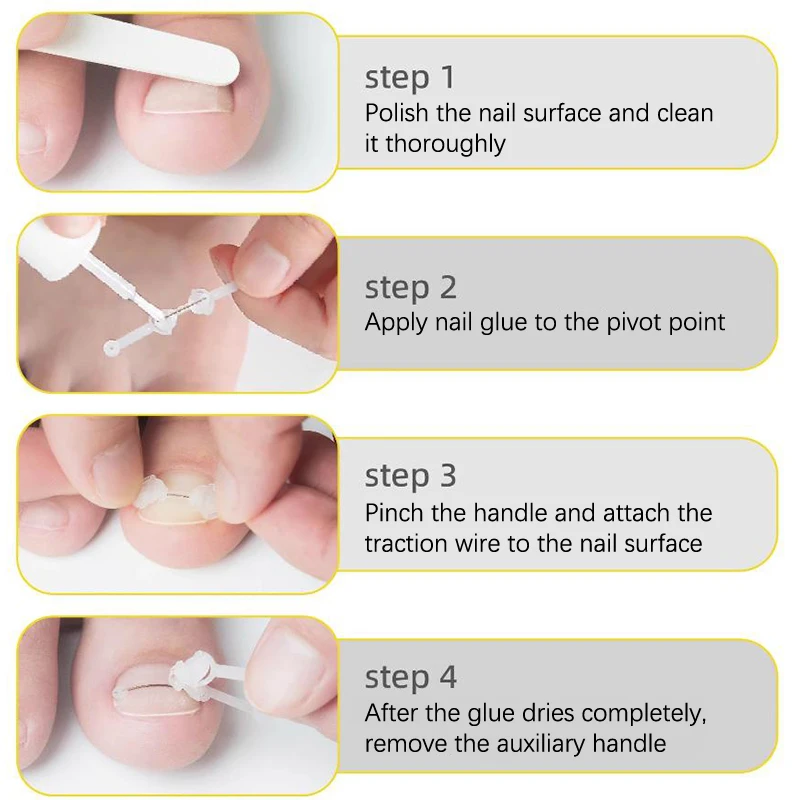 Kit de corrección de uñas encarnadas, tratamiento de uñas encarnadas, parches de corrección elásticos, pegatinas, Clip alisador, soporte