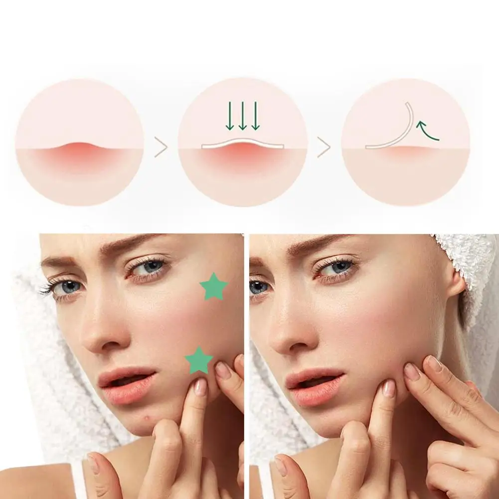 300/600 Stuks Ster Acne Patch Milde Niet-irriterend Verlicht Acne Hydrocolloid Acne Sticker Voor Mee-eters Gesloten Comedonen