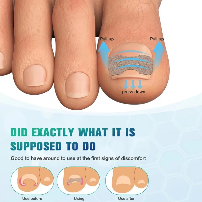 Adesivos de correção de unhas encravadas, corretor de unhas encravadas, tratamento de paroníquia, corretor de recuperação, ferramentas de pedicure