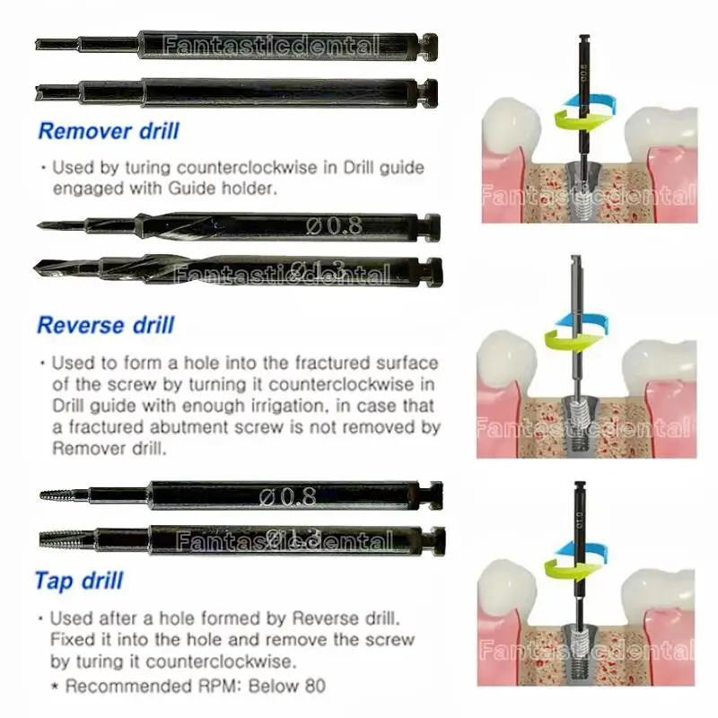 Dental 0.8mm/1.3mm Implant Fixture Fractured Broken Screws Removal SOS Remove Tap Extractor