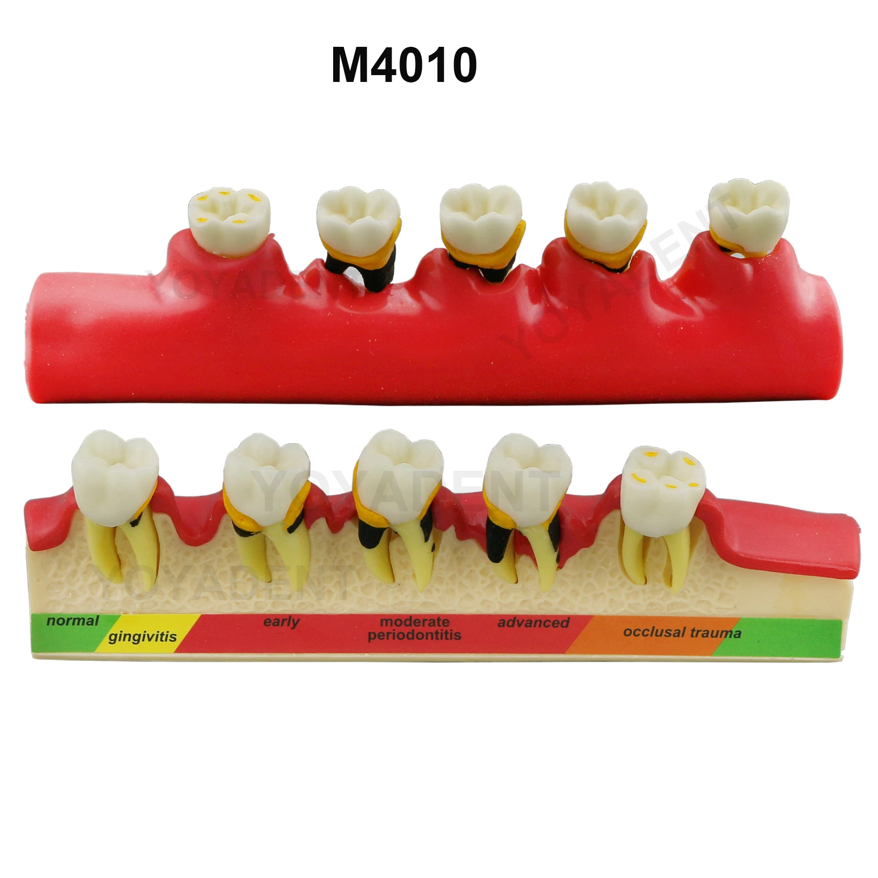 Dental Teeth Model 4-Stage Endodontic Treatment 5 Stages Periodontal Disease Model For Dentist Patient Communication Demo