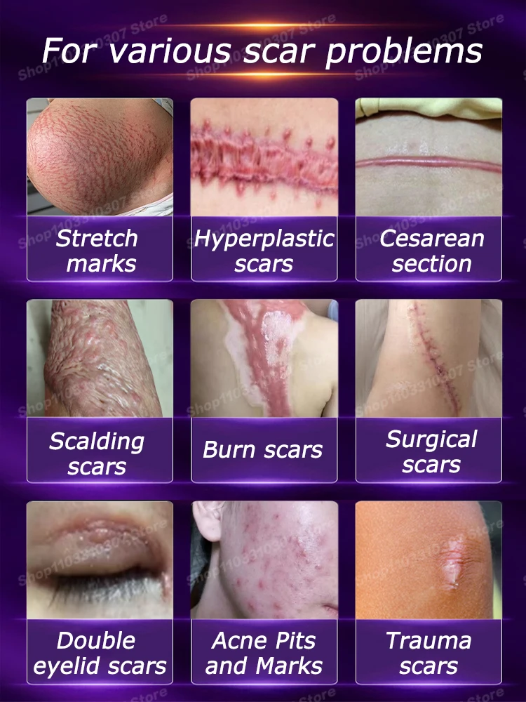 Scars  Fast Repair Removing  Keloid