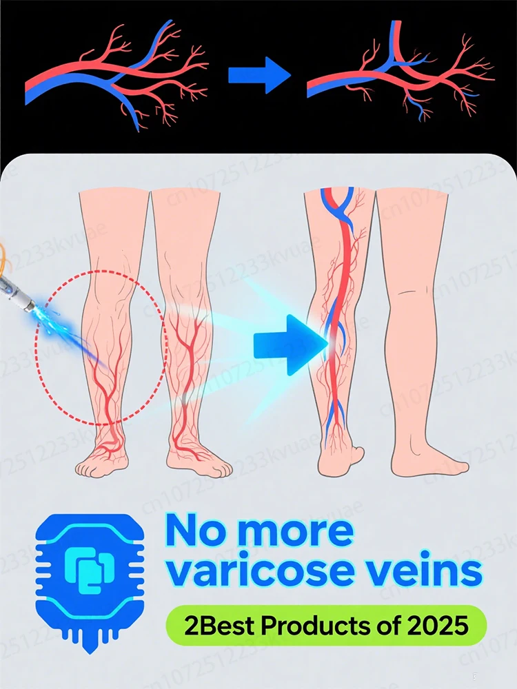 

Generation-8 Laser Says Goodbye To Spider Legs Varicose In 3 Days