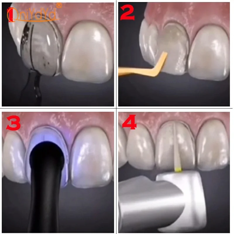 Forma dentystyczna do oklein z żywicy kompozytowej lekkie utwardzenie wypełniające przednie zęby foremka narzędzia do wybielania zębów