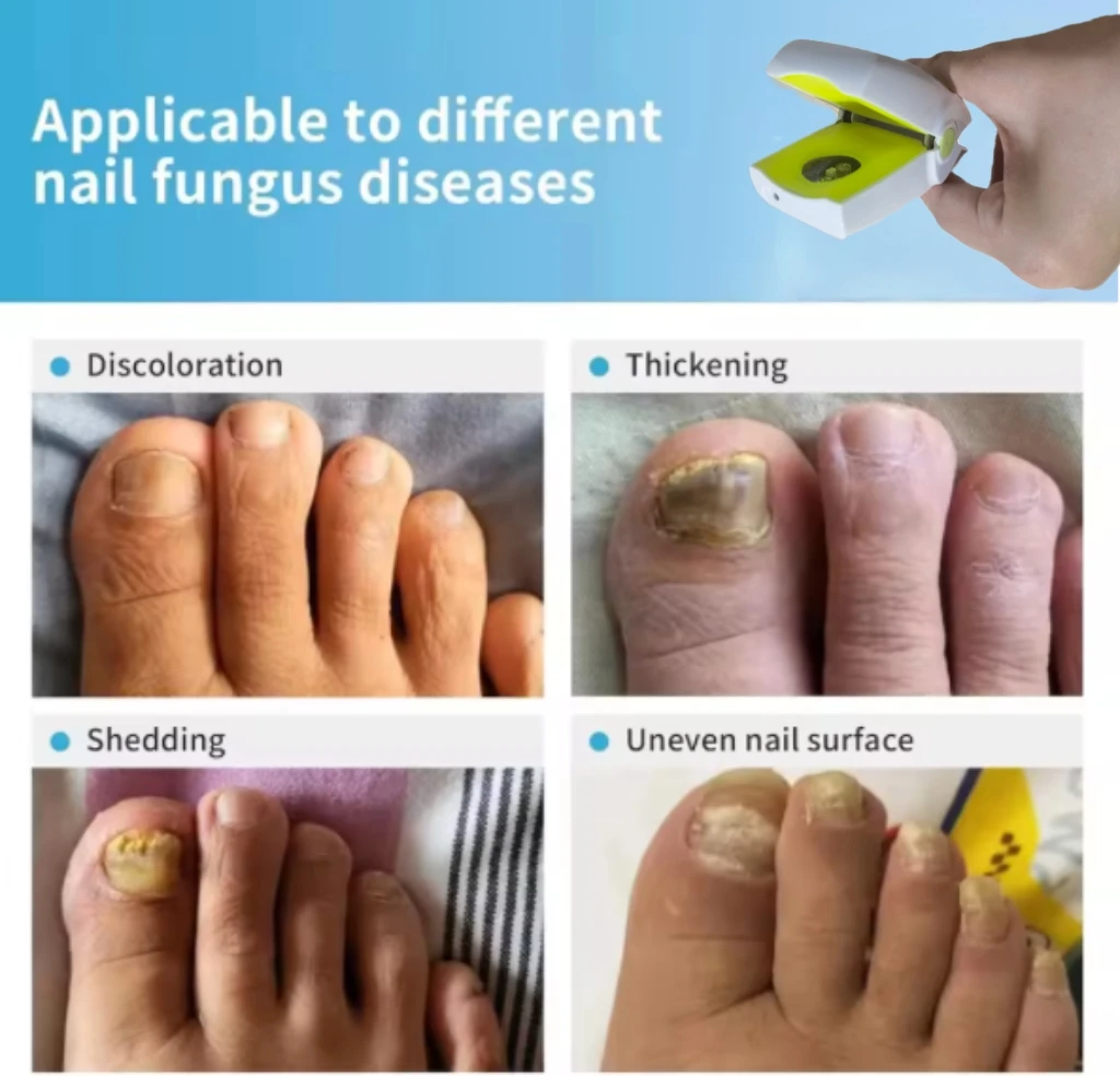 

Новое обновление 2025, лазерное устройство грибка ногтей HLKGO, усовершенствованная лазерная светотерапия для онихомикоза, интеллектуальный грибок ногтей на ногах