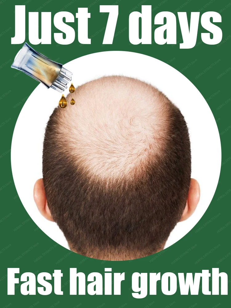 

Hair loss savior. Repair hairline. Say goodbye to baldness and hair loss
