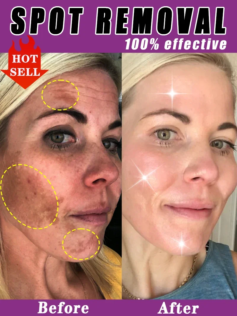 

Whitening Freckle Cream Dark Spot Remover Deep Melasma Age Sun Spots