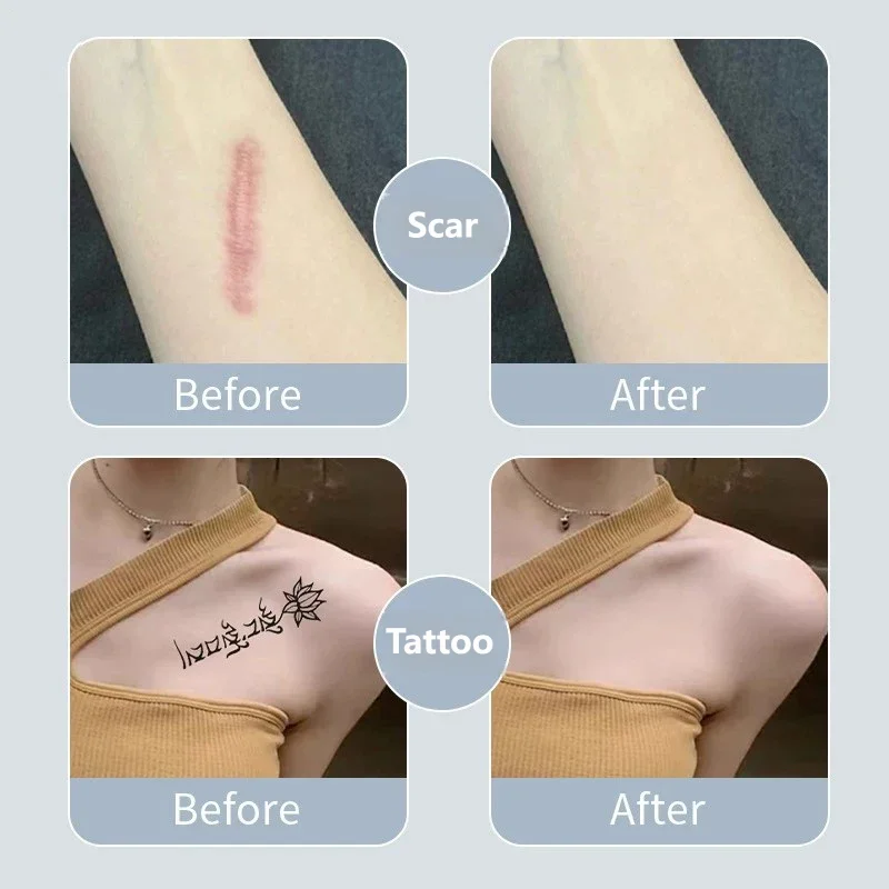 Flesh Tone Invisible Concealer Patch Waterproof Fake Skin Tape Cover Tattoo Scar Birthmark Stretch Marks Flaw Conceal Stickers