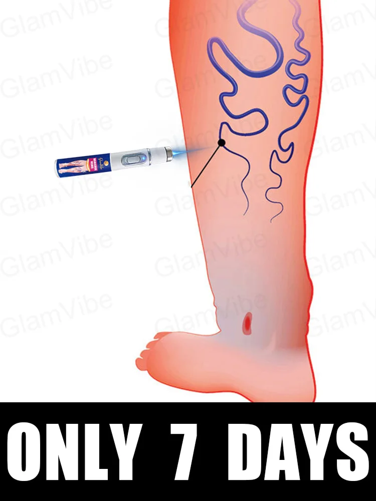 

Generation-2 Laser Says Goodbye To Spider Legs Varicose In 7 Days