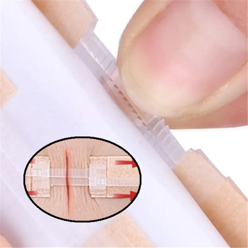 

1 шт., завязка на молнии, пластырь для закрытия ран, кровоостанавливающие пластыри, быстрая рана без швов, молнии, портативный, для улицы, для быстрой сгустки ран