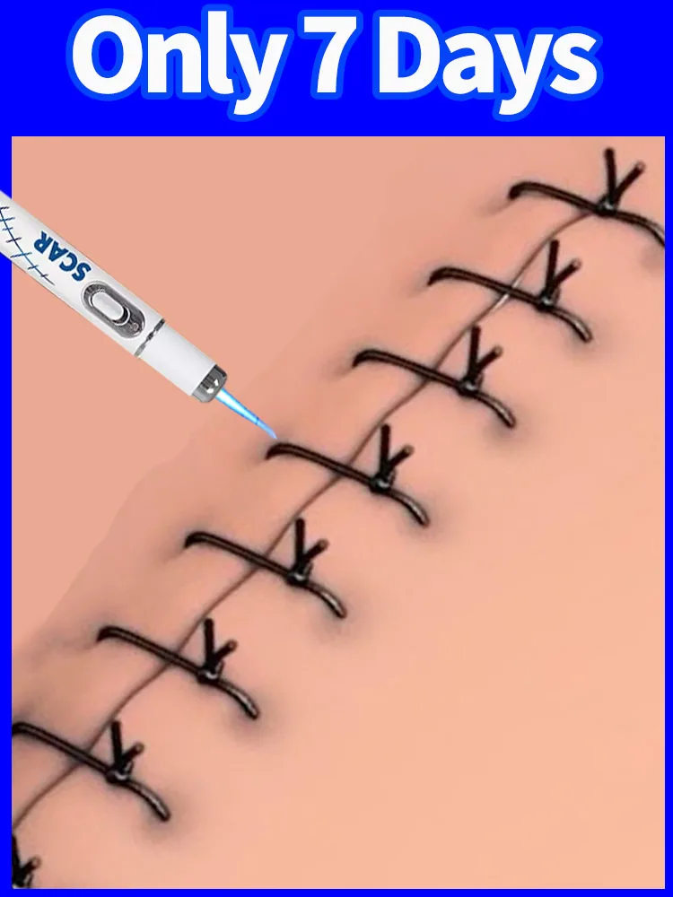 

blue light pen solve scars , hot sale scar care tools