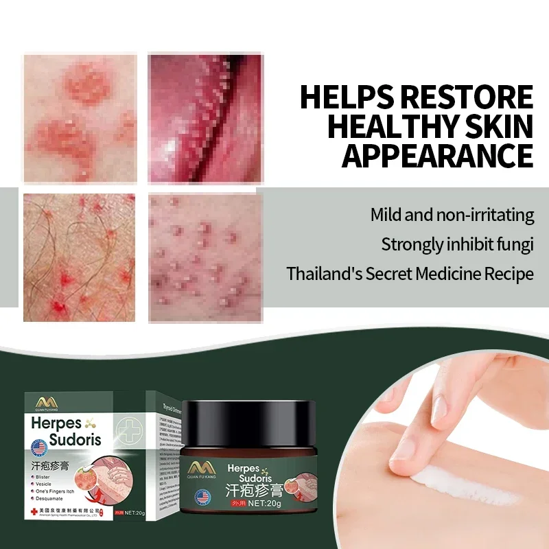 American Herpes Zoster Treatment Cream Shingles Cure Skin Medicine Snake Sore Red Dot Blister Herpes Simplex Ointment 20g