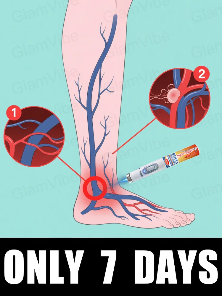 

Generation-2 Laser Says Goodbye To Spider Legs Varicose In 7 Days