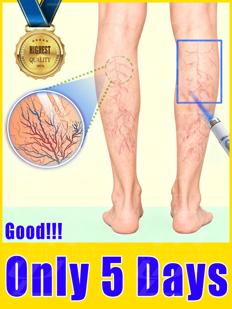 

Vᴀʀɪᴄᴏsᴇ ᴠᴇɪɴ ʟᴀsᴇʀ ɪɴsᴛʀᴜᴍᴇɴᴛ