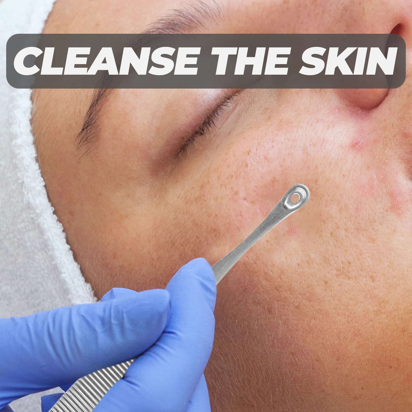 Ferramentas de remoção de acne doméstico cravo espinha cuidados com a pele removedor de maquiagem profissional