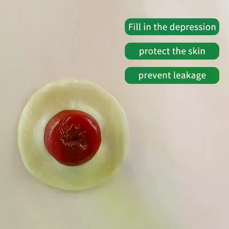 10Pcs Anti-Leakage Ring For Colostomy Bag Ostomy Paste Ring Baseplates Stoma Care Products To Protect Skin