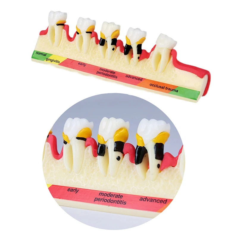 

Dentistry Teeth Caries Evolution Decayed Teeth Analysis Model Dental Caries Classify Model Demonstration Teach Study Teeth Model