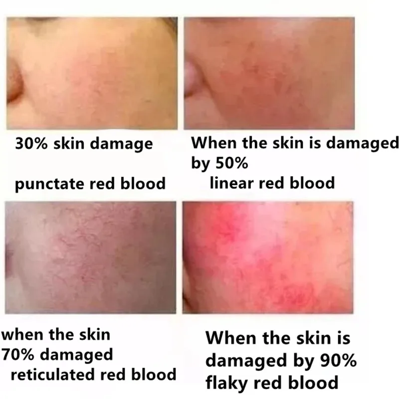 30ML Anti-Spider Vein Essense Face Redness Removal Red Blood Silk Repair Essential Oil Sensitive Skin Face Treatment