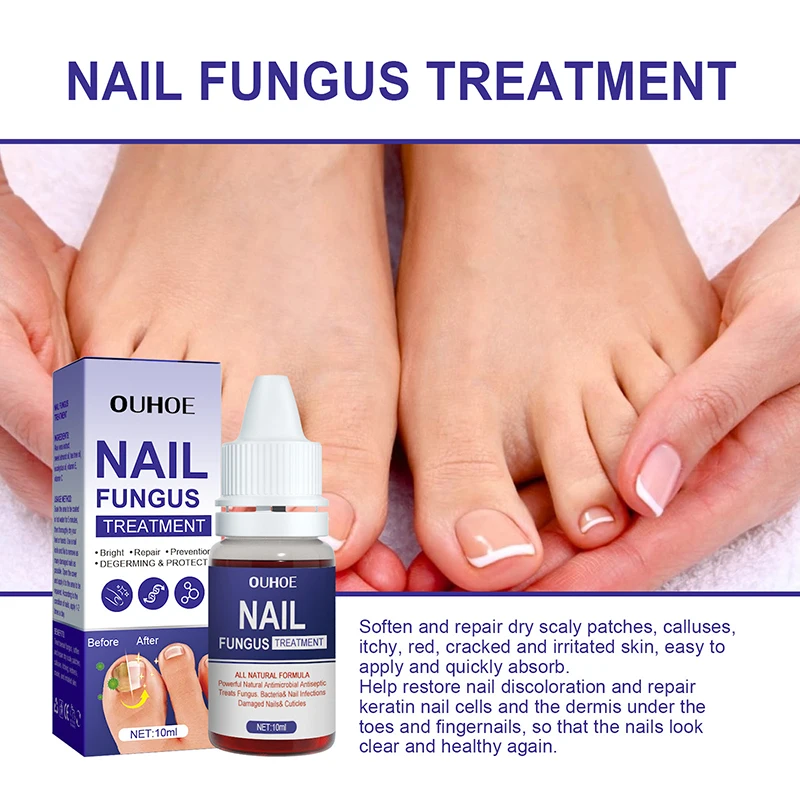 New Repair Nail Fungus Treatments Essence Anti Fungal Nail Treatment Repair Finger Toe Care Nail Fungus Liquid