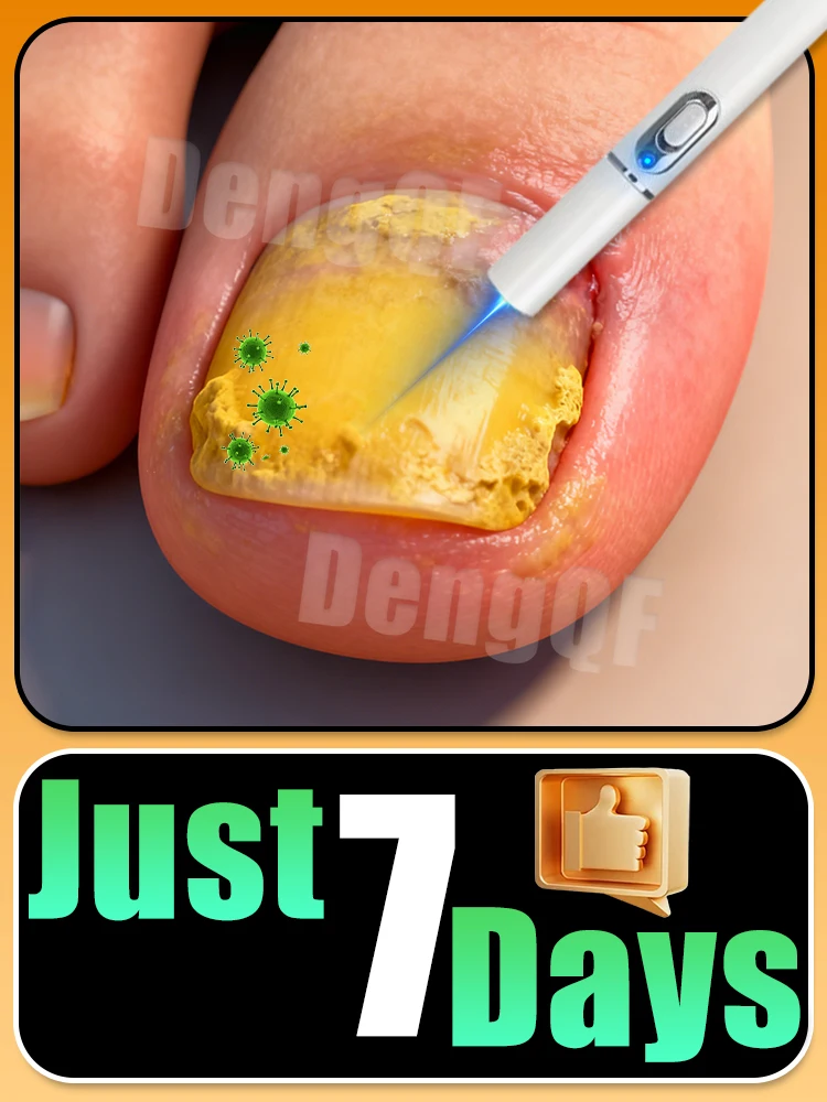 

A good nail laser pen, let the new generation of technology protect your nail health.