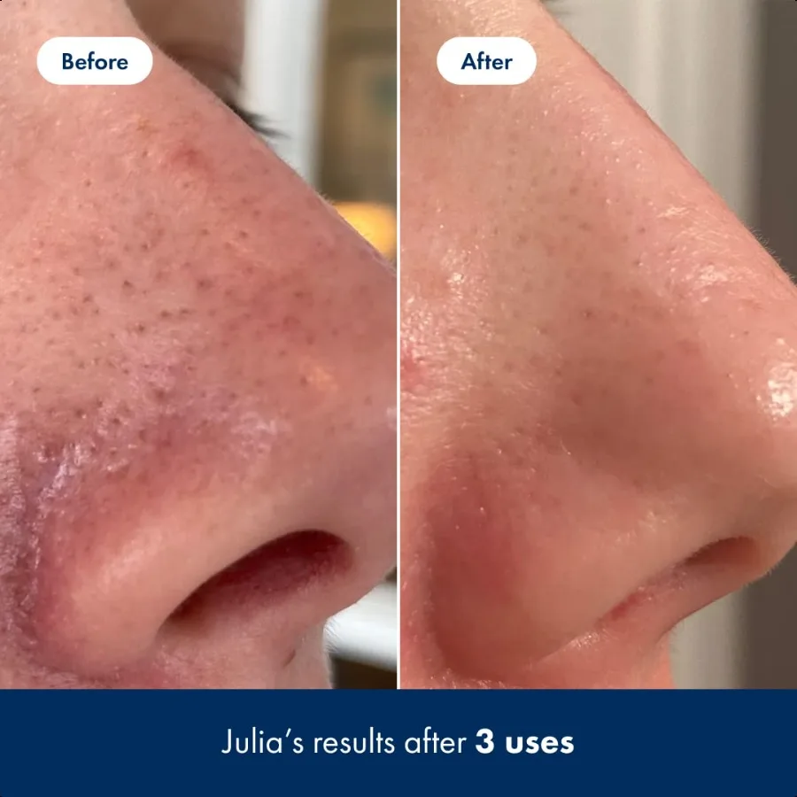Pore Release Blackhead Clearing Solution Exfoliating 2 Salicylic Acid Toner Featuring AHA and PHA Blackhead Remover Toner 100 m
