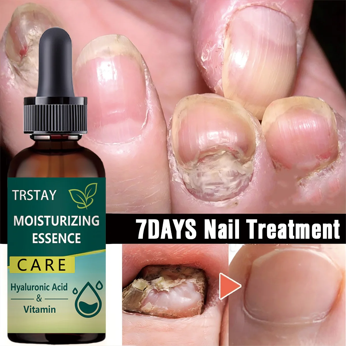 7DAYS Repair Nail Fungus Treatments Essence Foot Care Serum Toe Nails Fungal Removal Gel Anti-Infection