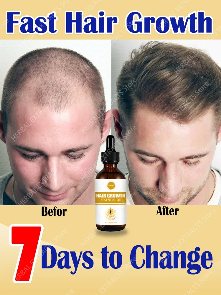 

O óleo de crescimento capilar faz o cabelo crescer rapidamente, repara eficazmente a calvície e a queda de cabelo hereditária
