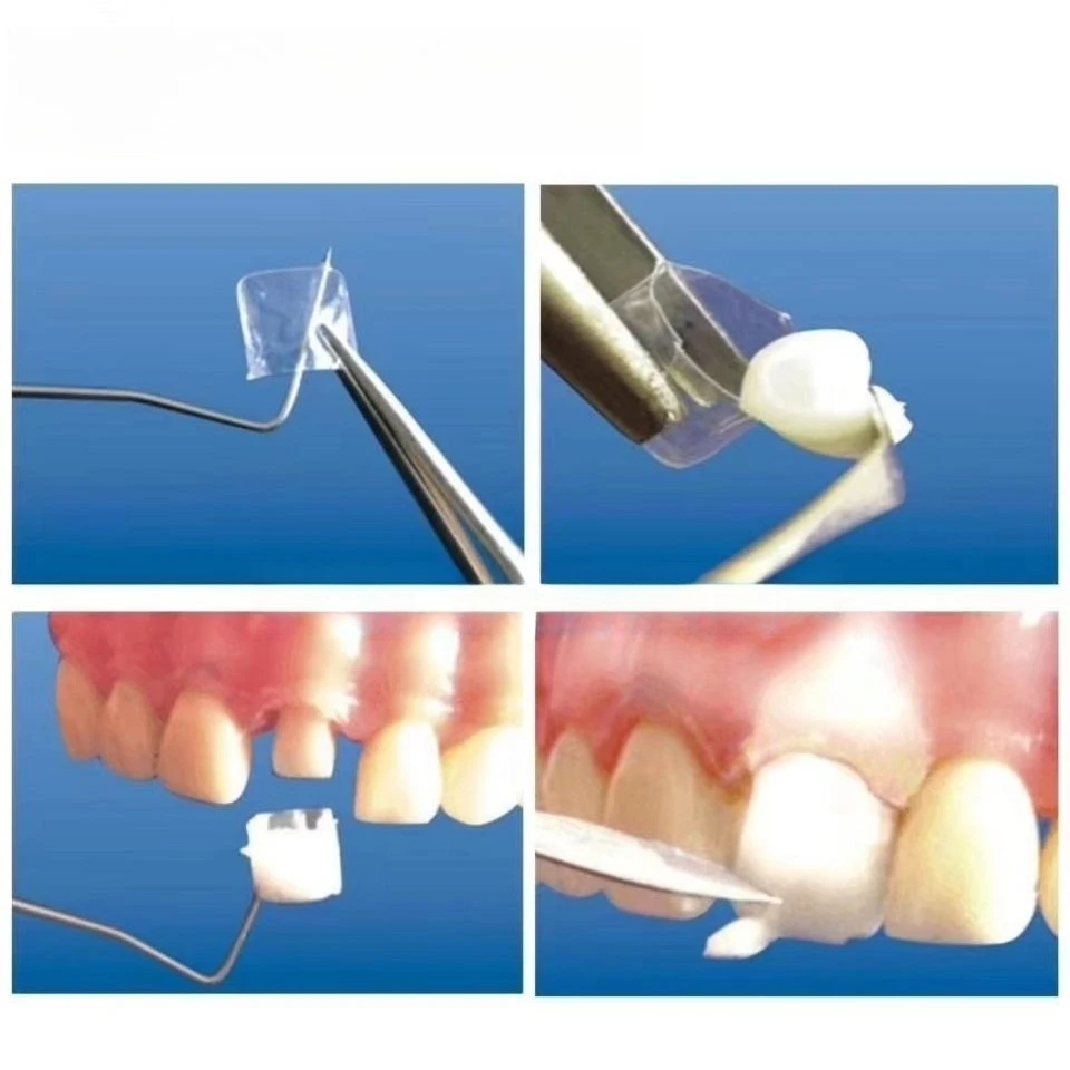 Best Crowns Transparent Temporary Preformed Molar Lab Anterior Posterior Teeths Deciduous 64pcs/Box Child Adult Kids Matrix Kit