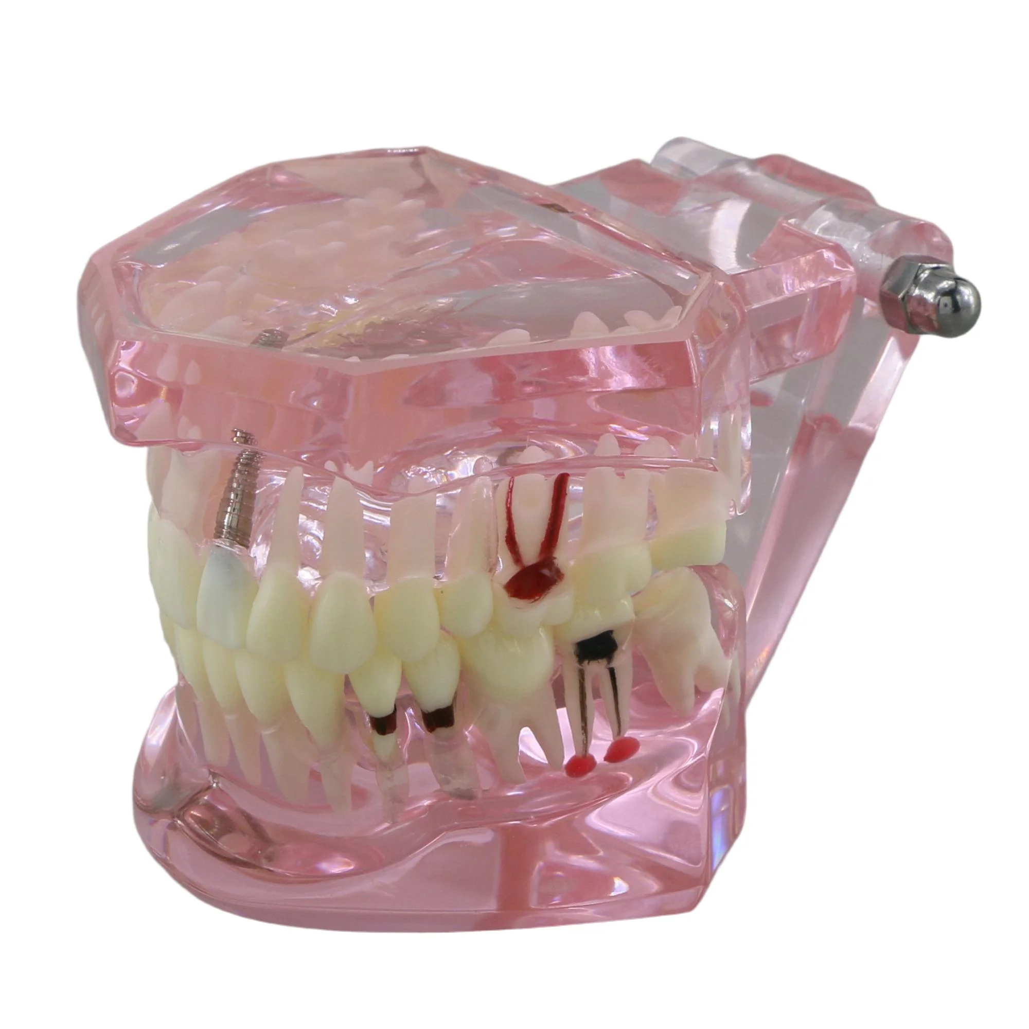 Teeth Model Oral Implant Restoration & Pathology M2001 Pink Used in student study