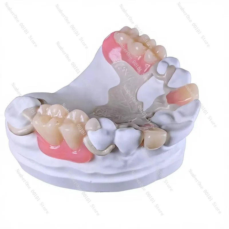 HPP PEEK Flexible Removable Denture Pure Titanium Base Resin Teeth Invisible Oral Denture for Elderly