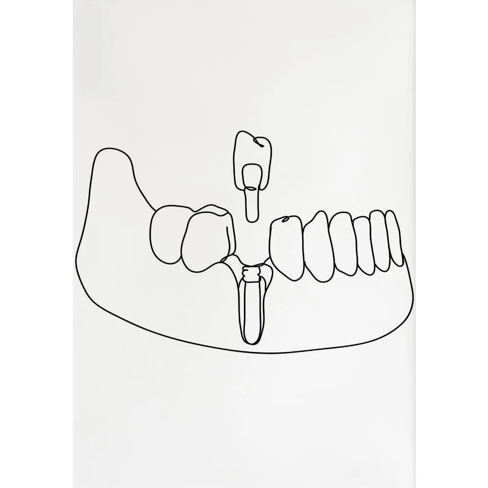 Tooth Implant Care Dental Clinic Orthodontics Posters Pictures Canvas Wall Art Home Decor Paintings for Living Room Decoration