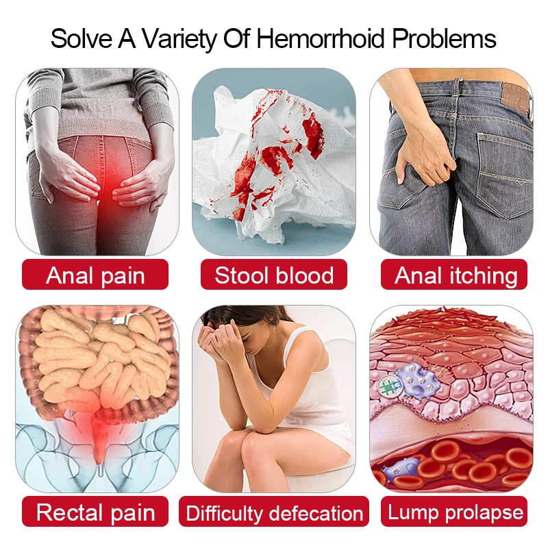 Pomada médica de hemorróidas para alívio da dor, sangramento anal, inchaço fissura anal, creme bacteriostático, G003