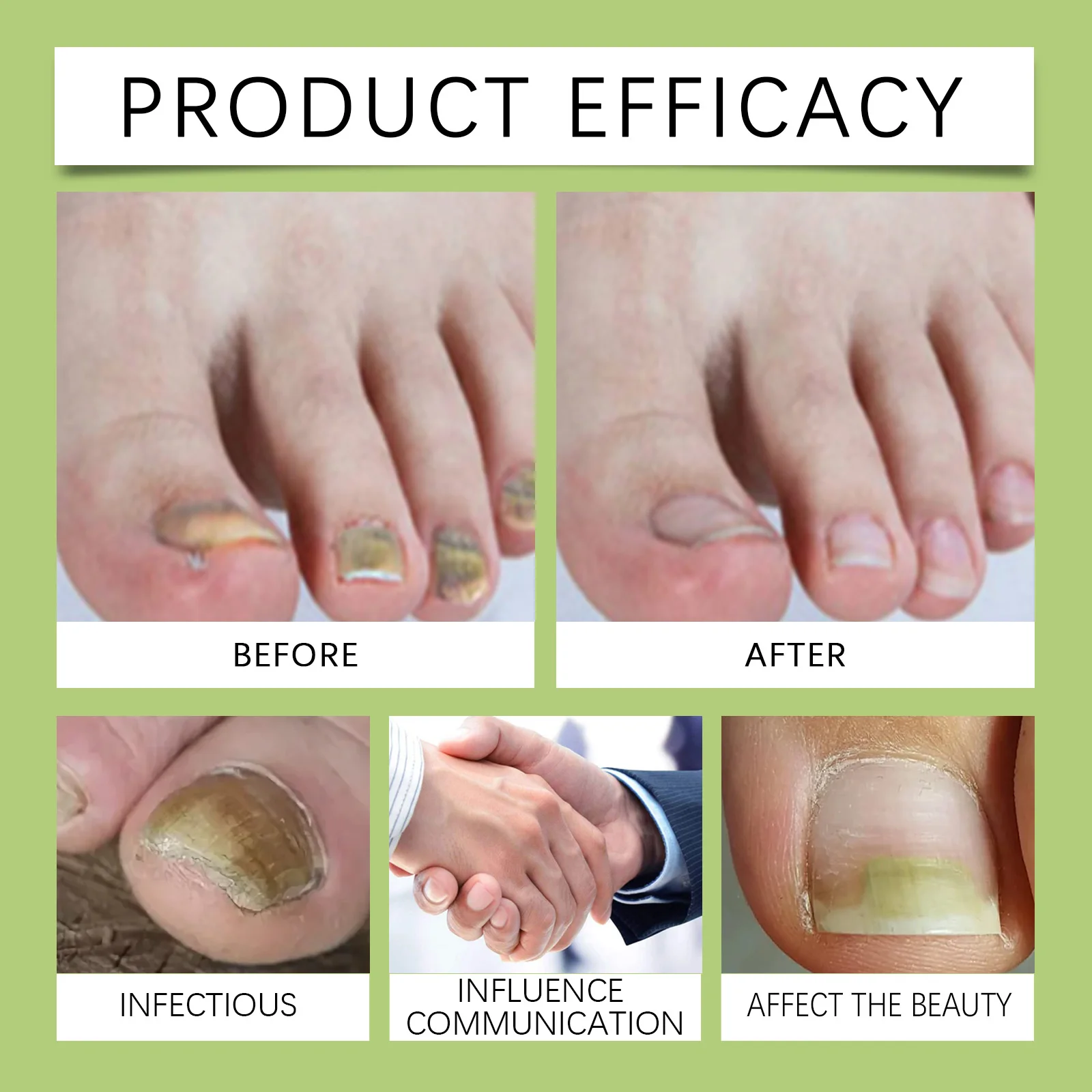 Onychomycosis Care Solution Fungus Nail Treatment Removes Oily Feet Repair Nail Manicure For Cracked Hands And Feet Essence New