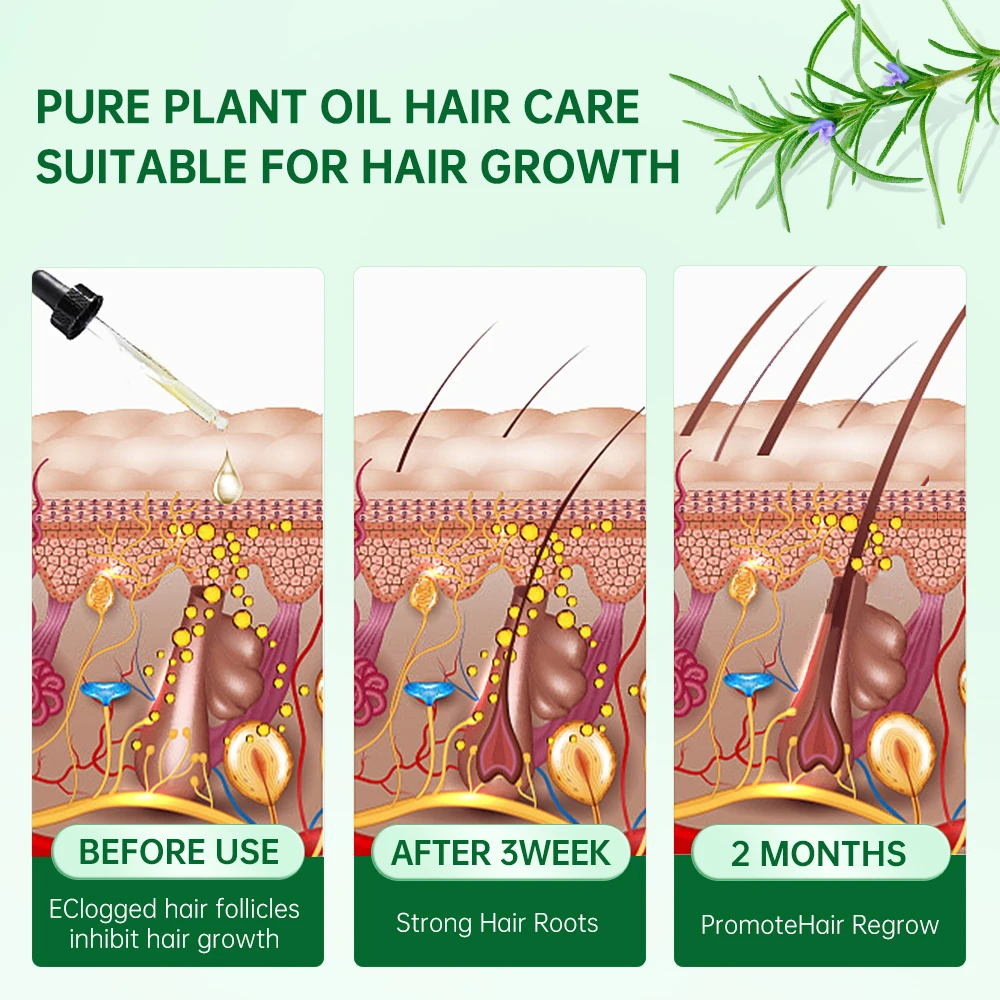 PURC 로즈마리 헤어 오일, 모발 개선 두피, 낮은 모발 볼륨, 수리 분기 헤어 케어, 모근에 영양 공급