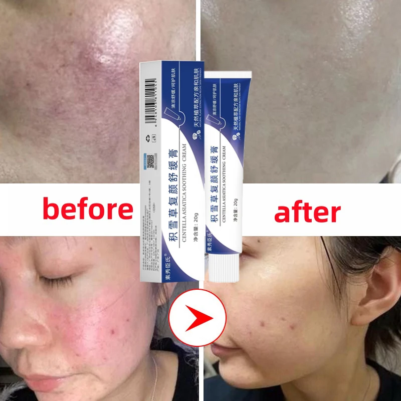 Natuurlijke Gezichts Roodheid Reparatie Crème Effectieve Kalmerende Rode Bloed Rosacea Behandelen Gevoelige Huid Gevoelige Huid Koreaanse Cosmetica