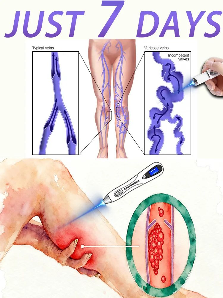 

Средства по уходу для снижения дискомфорта ног, улучшения кровообращения, ручки для варикозного расширения вен, средства по уходу за кожей.