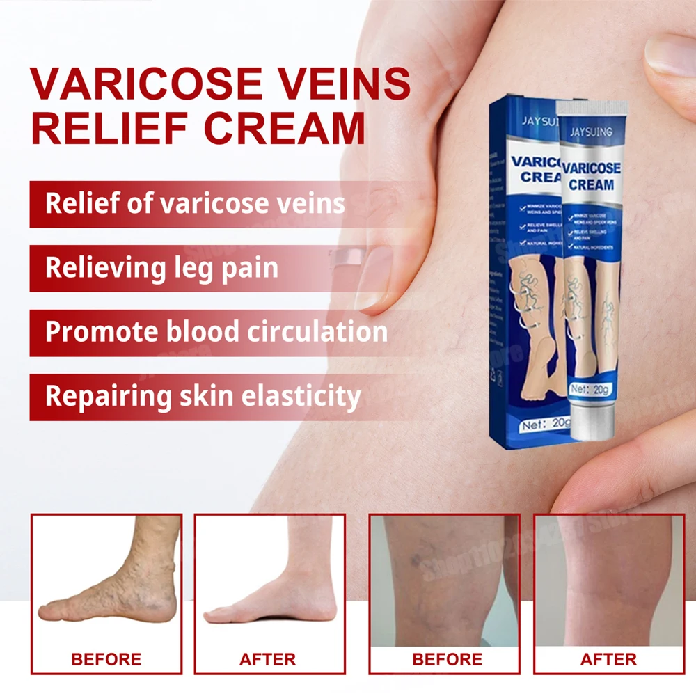 

Varicocele Cream: Contract varicose veins in the legs, relieve swelling, nourish the skin for quick relief