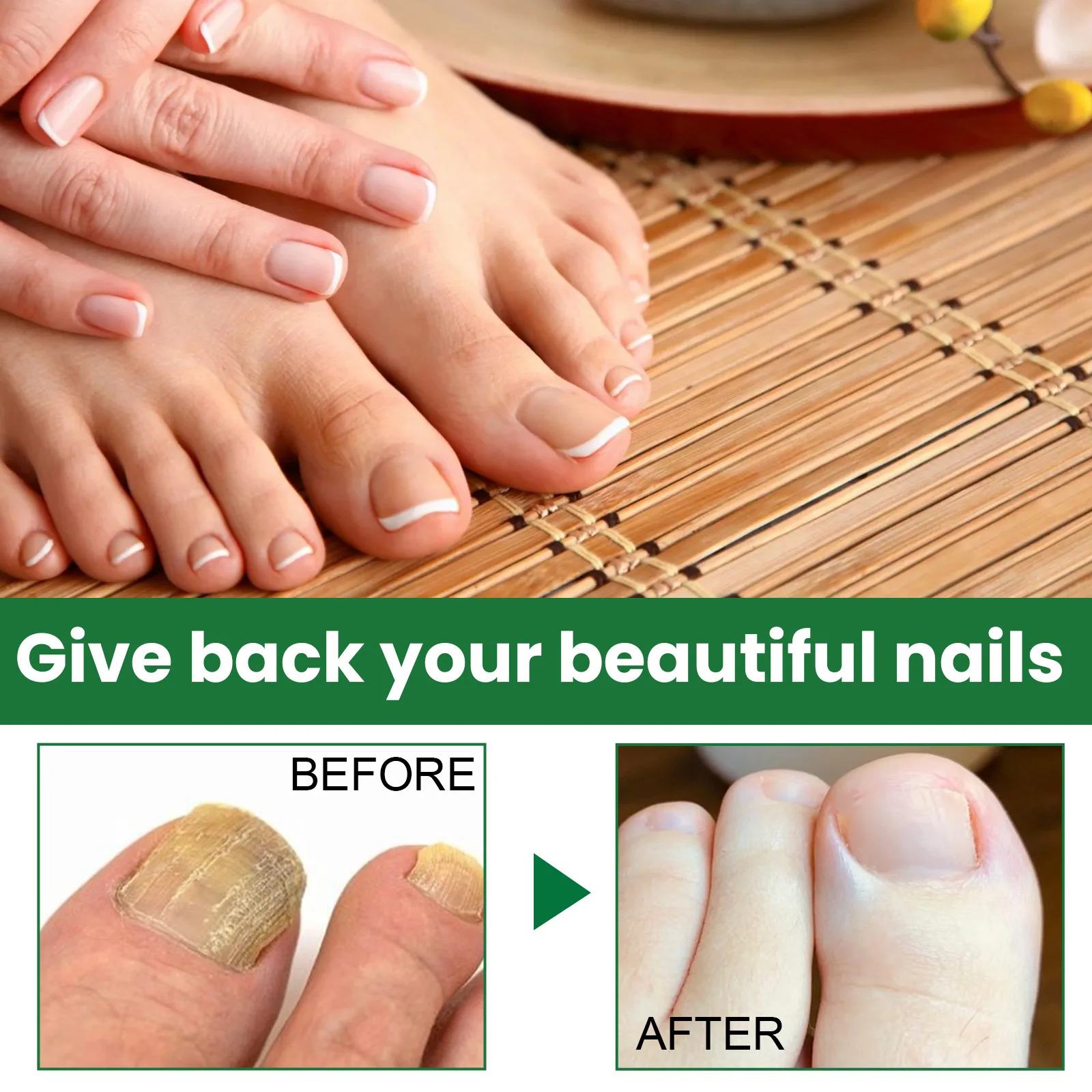 جهاز ليزر فطريات الأظافر علاج الأظافر الفطرية إصلاح فطار أظافر أظافر يزيل باديكير العناية بالقدم الفطريات نام