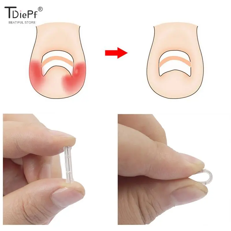 10 pc/box ferramenta de correção de unhas encravadas toe tratamento de unhas adesivo de remendo elástico alisamento clipe cinta pedicure ferramenta