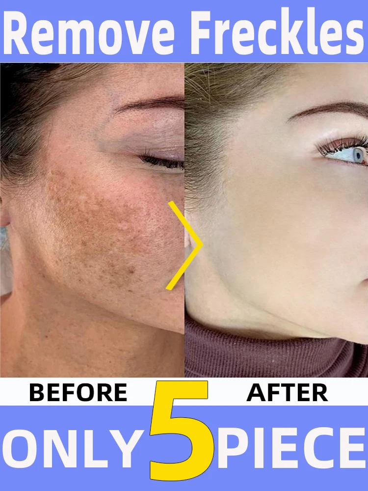 Lentiggini Chloasma Sun Age Dark Spot Clear