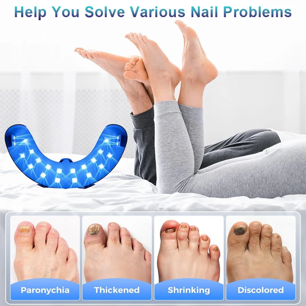 爪真菌レーザー装置複数の足の爪 905nm470nm 7 分無痛陥入爪カルシウム爪真菌治療を除去