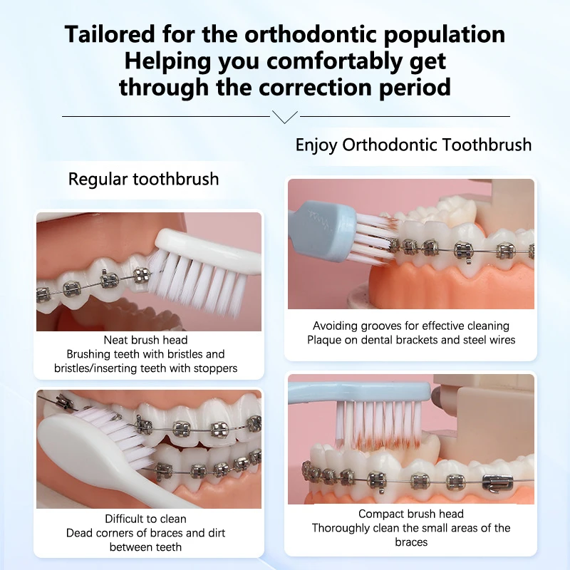 1 Stuks Diep Schoon Orthodontische Beugels Volwassen Orthodontische Tandenborstels Tandheelkundige Zachte Tandenborstel Met Stofkap Voor Volwassenen