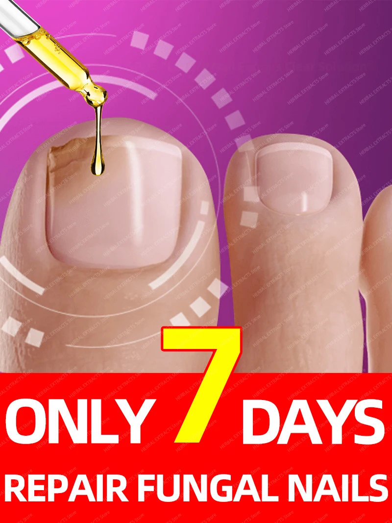

Destroy nail fungus and sterilize nails with this