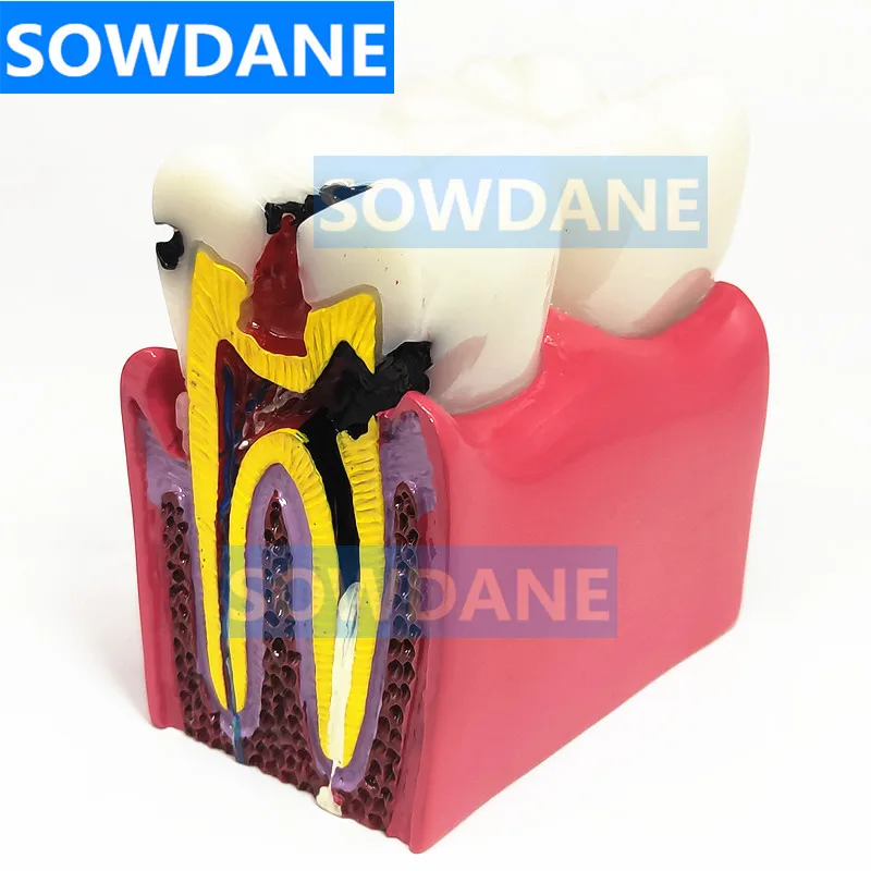 1pc Dental Anatomy Education Teeth Model 6 Times Caries Comparation Study Models For Dentist Studying and Researching