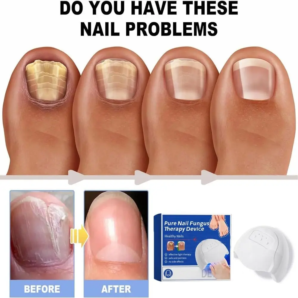 for Toenail Diseases Pure Nail Photo Therapy Device High-Efficiency for Fungal Nail Light Therapy Device Portable Easy to Use