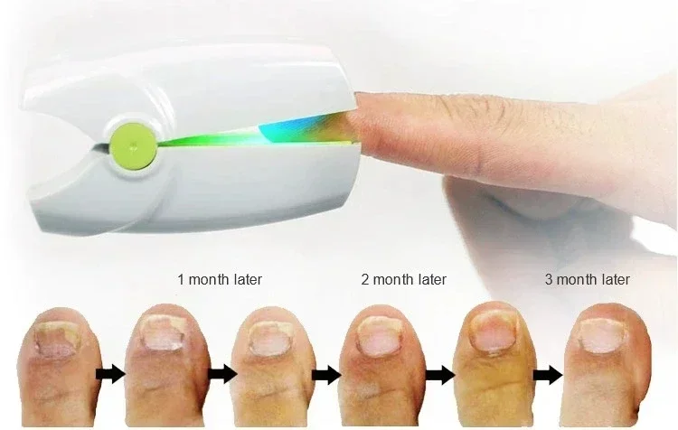 

Fungal Nail Laser Device Repair Fast Nails Fungus Onychomycosis Toenail Fingernail Cleaning Nail Fungus Relief Device Foot Care