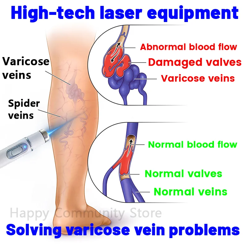 

High-tech laser equipment Solving varicose vein problems Spider veins
